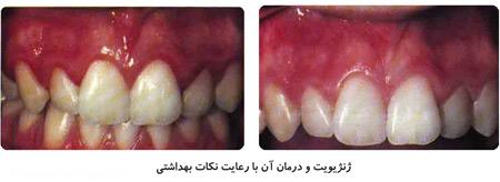  انواع بیماری های لثه و راهای درمان آن 