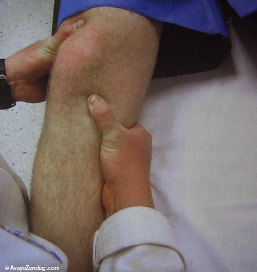تمرینات توانبخشی التهاب تاندون کف پایی