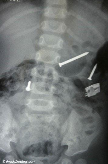  عجیب ترین عکس‌های رادیولوژی (16+) 