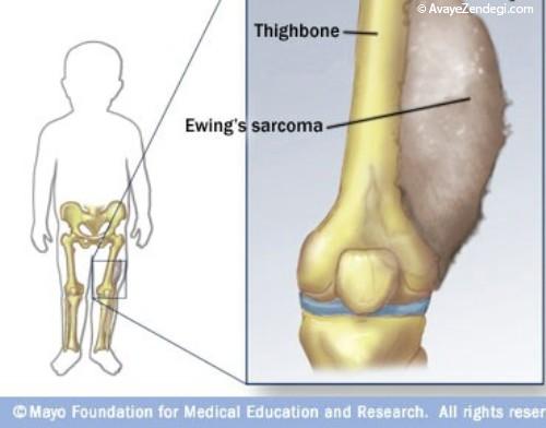  سارکوم یوئینگ، تومور سرطانی نوجوانان 