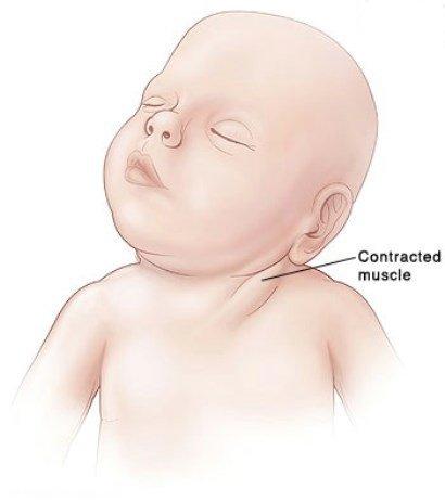تورتیکولی یا کجی گردن نوزاد چیست؟