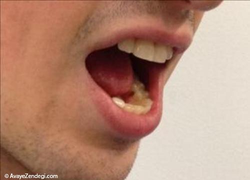 چطور سوزش دهان را کاهش دهیم؟