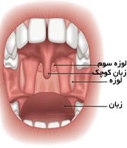 وقتی لوزه سوم بزرگ می شود