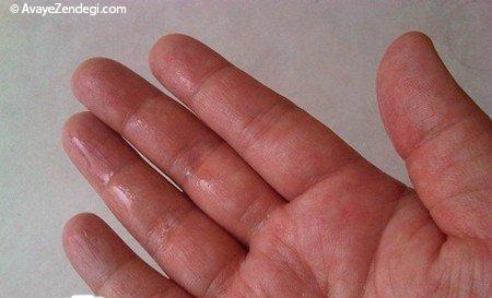 علت عرق کف دست و درمانی برای عرق کف دست