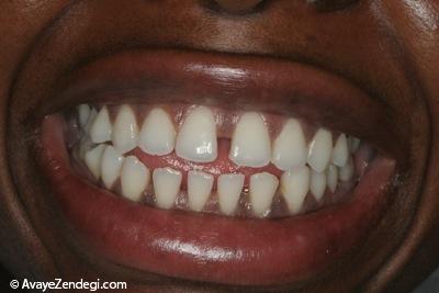 فاصله دندانی چیست؟