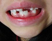  8 باور نادرست دندانی 