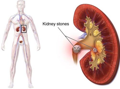 درمان گیاهی سنگ کلیه