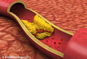 راههایی برای کنترل و پیشگیری از چربی خون