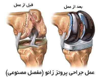 مشکلات بعد از جراحی مفصل زانو