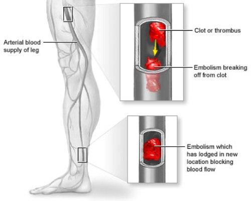 بیماری آمبولی شریانی؛ از علائم تا درمان