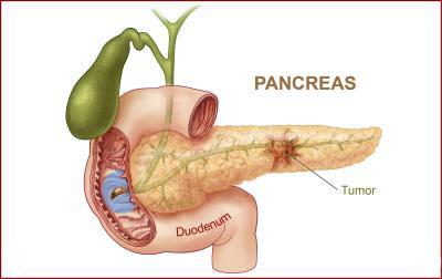 نشانه‌هایی ساده از سرطان پانکراس