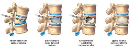ورتبروپلاستی روشی برای درمان شکستگی‌های ستون فقرات ‌