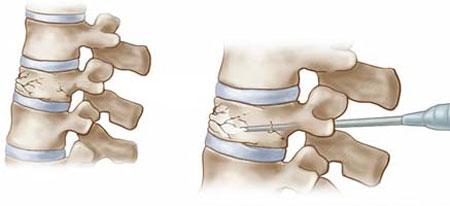 ورتبروپلاستی روشی برای درمان شکستگی‌های ستون فقرات ‌