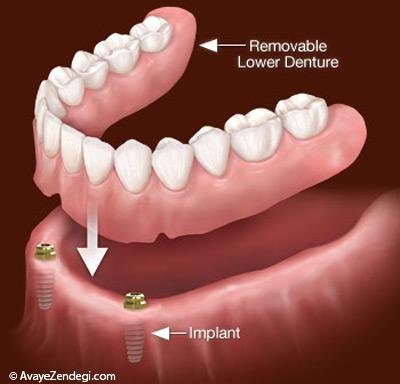 پروتز دندان و آشنایی با انواع پروتز دندان