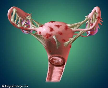  اطلاعاتی راجع به اندومتریوز، بیماری خطرناک زنان 