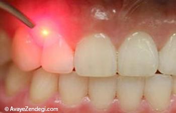  آبسه دندان و علائم و راههای درمان آبسه دندان و لثه 
